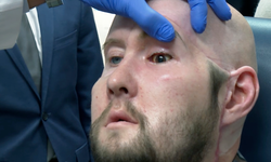 ABD’de bir hastaya ‘tam göz’ nakli yapıldı