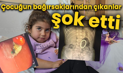 Çocuğun bağırsaklarından çıkanlar şok etti