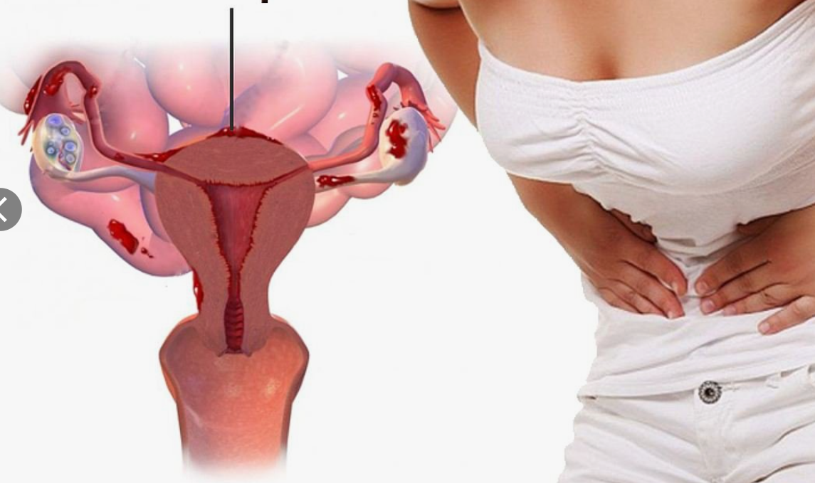 Endometriozis nedir? Belirtileri nelerdir?