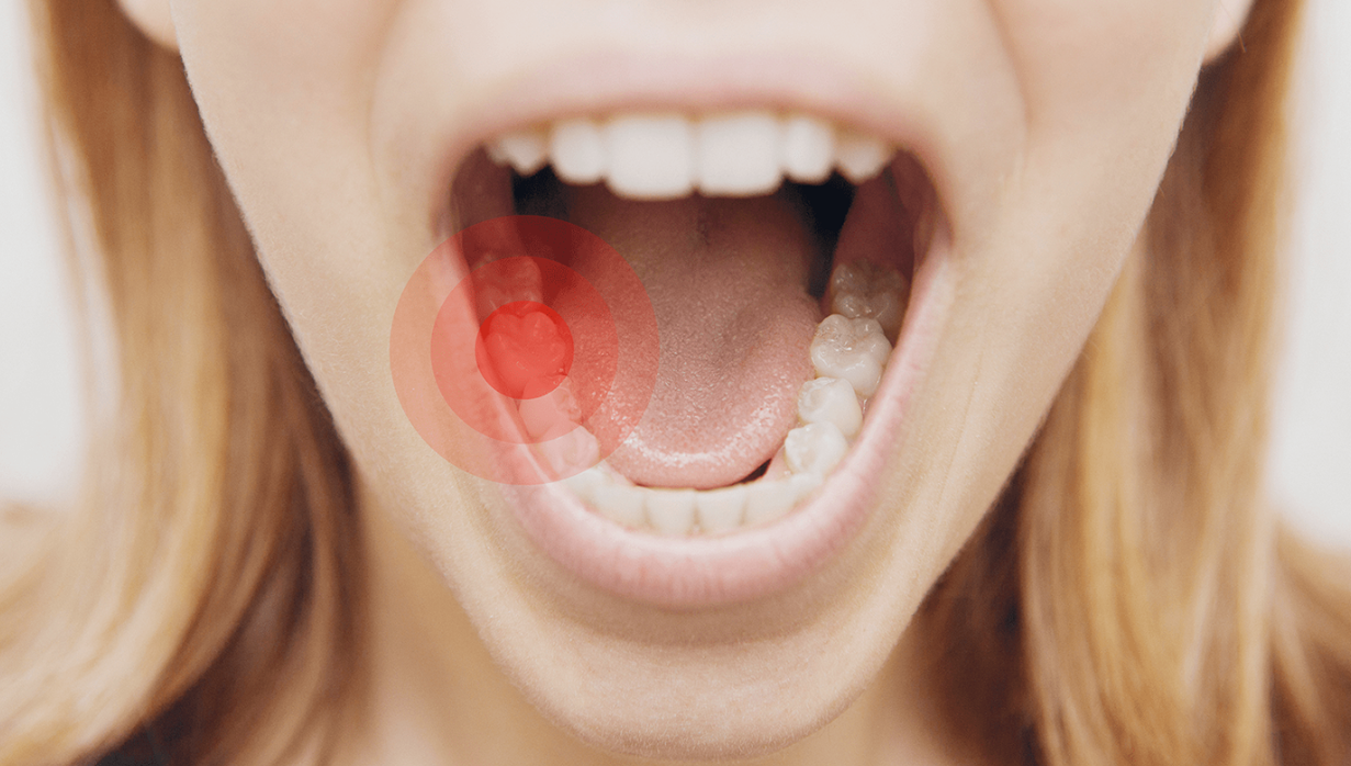 Yirmilik diş çekimi konusunda uzmanlar uyarıyor