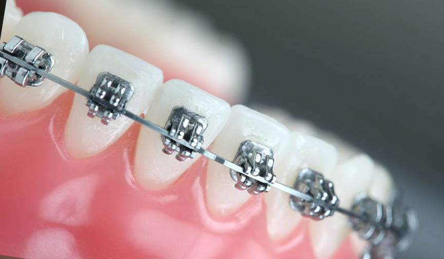 diş teli nedir nasıl tedavi edilir