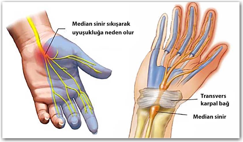 Karpal Tünel Sendromu